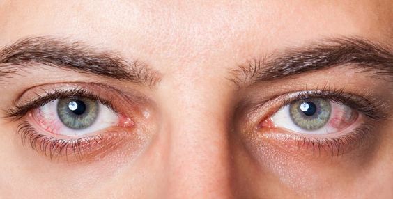 Uveíte: como tratar de forma natural esse problema de visão