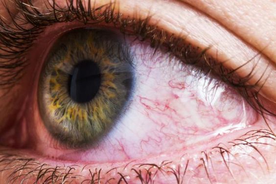 Vermelhidão nos olhos é uma queixa bastante comum entre meus alunos e seguidores nas redes sociais.