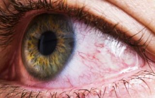 Olhos Com Secreção Demandam Cuidados Especiais