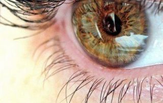 Catarata e Moscas Volantes: O Mito que Envolve essas Alterações Visuais
